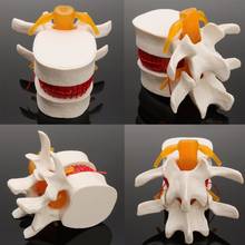 Dental 1:1 Human anatomy skeleton Spine Lumbar Disc Herniation Teaching Model 2024 - buy cheap