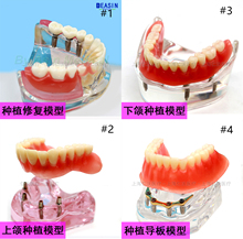 Dental implant DemonstrationTeeth Model for teaching and dentist student learning Deasin 2024 - buy cheap