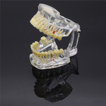 1 X Dental Implant Disease Tooth Pathological Extrusion Missing Teeth Model New For Dentistry Lab 2024 - buy cheap