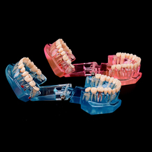 2021 Dental Implant Disease Teeth Model With Restoration Bridge Tooth Dentist For Medical Science Dental Disease Teaching Study 2024 - buy cheap