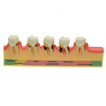High Quality New Dental Periodontal Disease Assort Tooth Typodont Model Free Shipping Dental mold dentistry tool 2024 - buy cheap