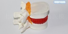 demonstration model of lumbar vertebral spine model Human lumbar disc herniation model free shipping 2024 - buy cheap