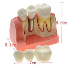 new arrival  New Sale Dental Demonstration Teeth Model Implant Analysis Crown Bridge Dental mold dentistry equipments 2024 - buy cheap