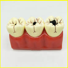 4 vezes dentes da doença da dentadura modelo cárie decomposição cárie modelo de dente para o ensino de comunicação de demonstração médica dental 2024 - compre barato