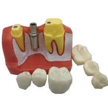Стоматологический имплантат M2017, модель зубов для обучения, 4-кратная Стоматологическая Смола, Кварцевая резина, модель зубов, стоматологическая тренировочная модель 2024 - купить недорого