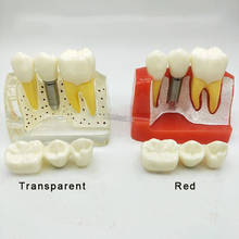 Modelo dental removível para implante, ponte de coroa para odontologia 2024 - compre barato