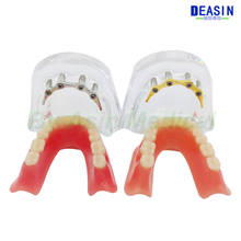 1 pc x high quality Resin Coverage dental implant model dentures Removable teeth model for dentist study Deasin 2024 - buy cheap