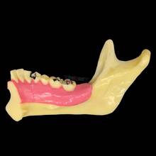 Modelo anatômico de demonstração de dentes mandibulares dentais, modelo para estudo de paciente, 1 peça 2024 - compre barato