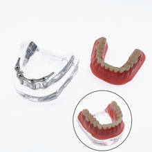 Modelo de reparación de dientes con implante, dentadura dentada de barra plateada, modelo mandibular, modelo de enseñanza Dental 2024 - compra barato