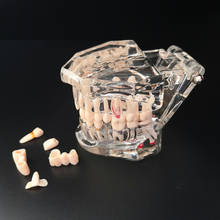 Implant Dental Disease Teeth Model With Restoration Bridge Tooth Dentist For Medical Science Dental Disease Teaching Study Tool 2024 - buy cheap