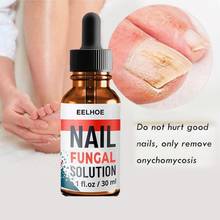 10/20/30ml Foot Anti-fungal Serum To Remove Onychomycosis Repair Treatment  Fluid Liquid Healthy Nail Care Repair Liquid TSLM1 2024 - buy cheap