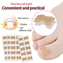 4-60Pcs Non-Glue Toenail Patch Ingrown Toenail Correction Pedicure Tool Toe Inlay Nail Corrector Nail Patch Correction Stickers 2024 - buy cheap
