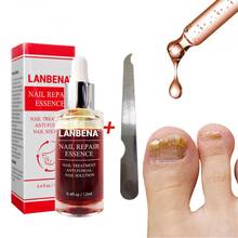 LANBENA Fungal Nail Repair Essence Serum Care Finger Toe Anti Nail Repair Footcare Fungal Nail Treatment Liquid TSLM1 2024 - buy cheap
