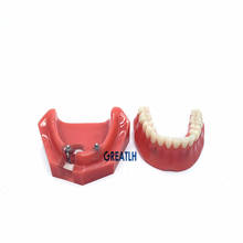 Modelo de implante Inferior para dentadura Dental, modelo de 2 implantes dentales, para enseñanza Dental 2024 - compra barato