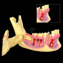 Modelo anatômico de demonstração de dentes mandibulares dentais, modelo para estudo de paciente, 1 peça 2024 - compre barato