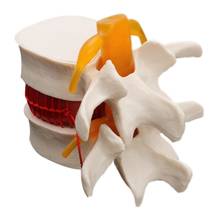 Nova anatomia humana esqueleto coluna lombar disco hérnia modelo de ensino crânio cérebro traumático material escolar instrumento médico 2024 - compre barato