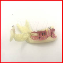 Orthodontic Braces Dental Mandibular Tissue Teeth Demonstration Anatomical Model Patient Study Teach Model 2024 - buy cheap