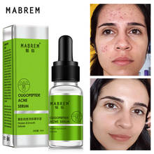 Eficaz acne poros tratamento soro cravos remover o controle de óleo rosto essência ácido hialurônico hidratante clareamento cuidados com a pele 2024 - compre barato