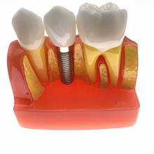 4 times planting Teeth model Analysis Crown Bridge Removable Model Dental Teaching Teeth Model 2024 - buy cheap