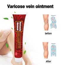 Pain Varicosity Angiitis Ointment Varicose Veins Symptoms Pain Nodules Acidity Numbness Treatment Cream Health Care 2024 - buy cheap