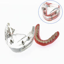 Dental Model With Implant Overdenture Inferior Demo Teeth model Study Model 2024 - buy cheap