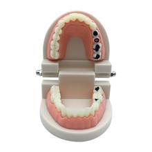 Modelo de decaimiento Dental, herramienta para enseñar Caries dentales, 1 unidad 2024 - compra barato