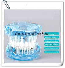 Modelo de dientes de implante Dental M2001/modelo de dientes de puente fijo/modelo de dientes de caries dentales modelo de enseñanza dental 2024 - compra barato