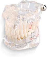 Прозрачная модель зубных протезов, модель зубного импланта, обучение стоматолога, студентов, обучение, коммуникация по исследованиям 2024 - купить недорого