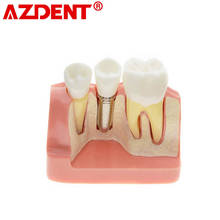 Análisis de implante de Modelo Dental, puente de corona, demostración de dientes, modelo para educación con ZYR-2017 de coronas extraíbles 2024 - compra barato