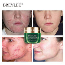 BREYLEE Tea Tree Acne Treatment Face Cream Anti Acne Remove Pimple Spot Oil Control Shrink Pore Moisturizing Whitening Skin Care 2024 - buy cheap