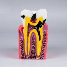 Dental Anatomy EducationTeeth Model M4021/6 Times Caries Comparation Study Model Dentist Studying/dental caries plastic model 2024 - buy cheap