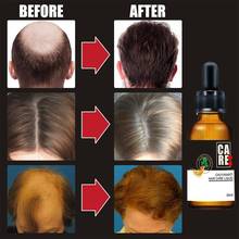 Hair Growth Oil Essence Thickener For Hair Extract Growth Growth Hair Hair Natural Product Treatment Loss Plant Product P9J0 2024 - buy cheap