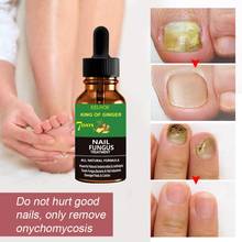 Nail Repair Liquid Nail Fungus Removal Foot Antifungal Nail Essence Remove Onychomycosis Repair Treatment Nail Care TSLM1 2024 - buy cheap