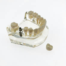 Modelo de ponte para implante dentário, modelo com jardineira inferior de mordente mancal 2024 - compre barato