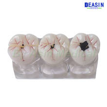 Dental model four times caries evolution caries model tooth demonstration doctor-patient communication caries development proces 2024 - buy cheap