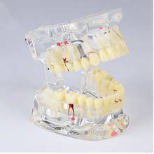 Dental Study Tooth Transparent Adult Pathological Teeth Model/Dental Implant Disease Teeth Model M4001/ Implant Disease Model 2024 - buy cheap