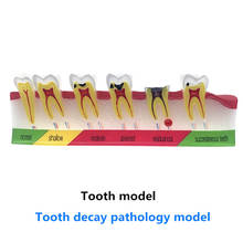 Кариесы для зубов, классификация модели зубов, модель патологического процесса вокруг зубов, модель кариеса для зубов 2024 - купить недорого