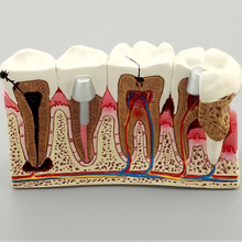 Implante Dental modelo de dientes M4029, modelo de Caries dentales, educación de patologías dentales, modelo de dientes para estudio 2024 - compra barato