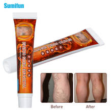 2Pcs Sumifun Varicose Veins Treatment Cream 100% Original Vasculitis Phlebitis Spider Leg Pain Relief Ointment Medical Plaster 2024 - compre barato