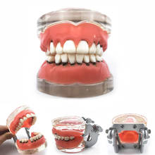 Adult Pathological Periodontal disease #4017 Oral Education Dental Study Teeth Model Adult Pathological Periodontal disease #4017 Oral Education Dental Study Teeth Model