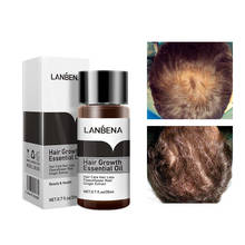LANBENA быстро мощные средства с эссенцией для рост волос Эфирное Масло жидкое лечение Предотвращение выпадения волос уход за волосами Andrea 2024 - купить недорого