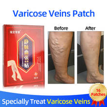 Spider Legs Veins Varicose Treatment Paste Varicose Veins Cure Plaster Natural Herbal Medically Care Health Product 2024 - buy cheap