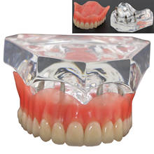 Modelo dental superior para dentaduras (overdentaduras), 4 implantes, modelo de demonstração 6001 02 2024 - compre barato