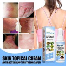 30ml Skin Psoriasis Spray Natural Herb Eczema Treatment Spray Itch Relief Improve Redness Dermatitis Psoriasis Spray Health Care